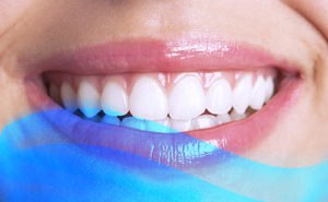 implantaten-mooie-witte-lach-gezond-gebit-tandarts-mondhygiëne